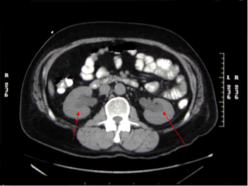 Computerized Tomography Scan Showing Bilateral Hydronep | Open-i