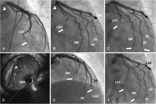 The Distal Embolization At Coronary Artery. A And B: Th | Open-i