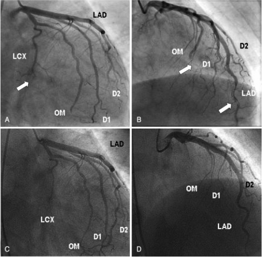 Coronary Angiography Finding. A And B: After Administra | Open-i