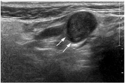 Transverse greyscale sonogram in a patient with carcino ...