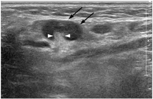 Transverse Greyscale Sonogram In A Patient With Reactiv Open I