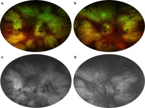 Fundus Autofluorescence Of Choroideremia Wide Field Color Photography A B Fundus Autofluorescence Of Choroideremia Wide Field Color Photography A B