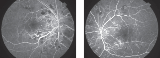 Purtscher Like Retinopathy Fluorescein Angiography Diffusion Of From Arterioles Capillaries And Retinal Purtscher Like Retinopathy Fluorescein Angiography Diffusion Of From Arterioles Capillaries And Retinal