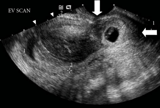 A gestational sac with a small embryonic pole with a fe | Open-i