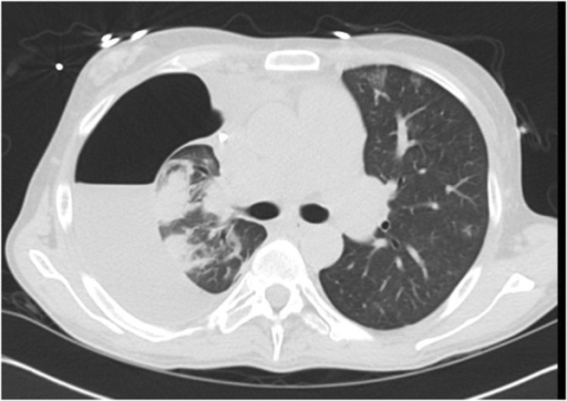 Chest CT post-OLT: Large right-sided hydropneumothorax | Open-i