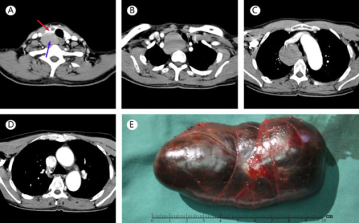 CT scanning and complete excision of giant thyroid goit | Open-i