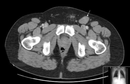 A CT scan of the pelvis revealing a 2.4 cm left inguina | Open-i