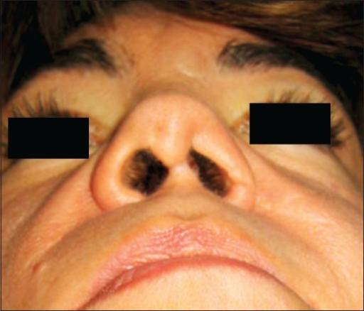 bad-open-rhinoplasty-scar-open-i