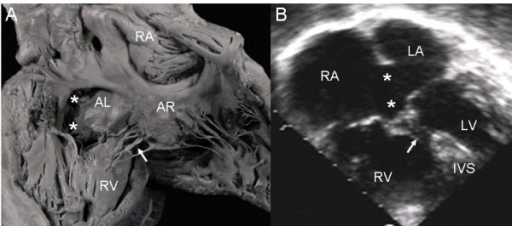 Atrioventricular septal defect with a Rastelli type A c | Open-i