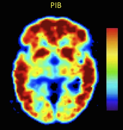 Results of a Pittsburgh Compound B (PiB) PET scan. PiB | Open-i