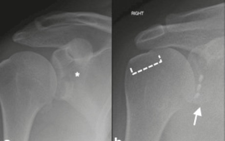 Posterior Shoulder Dislocation. Axial (AX) view demonst | Open-i