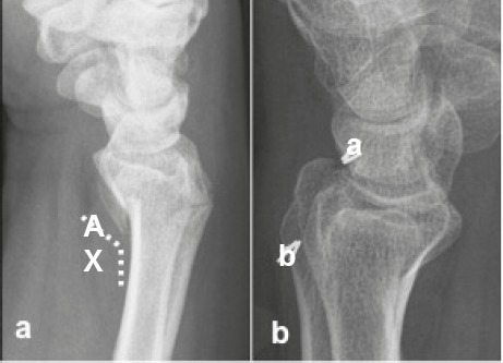 barton vs colles fracture