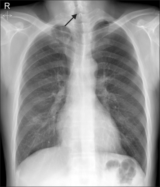 Tracheal Stenosis X Ray