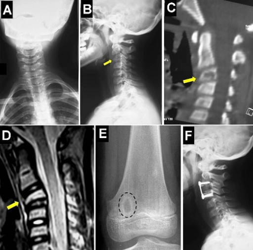young vs old cervical spine x ray