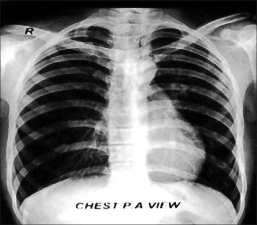 Chest X ray Showing Mediastinal Shift To Left Crowded Open i chest-x-ray-showing-mediastinal-shift-to-left-crowded-open-i