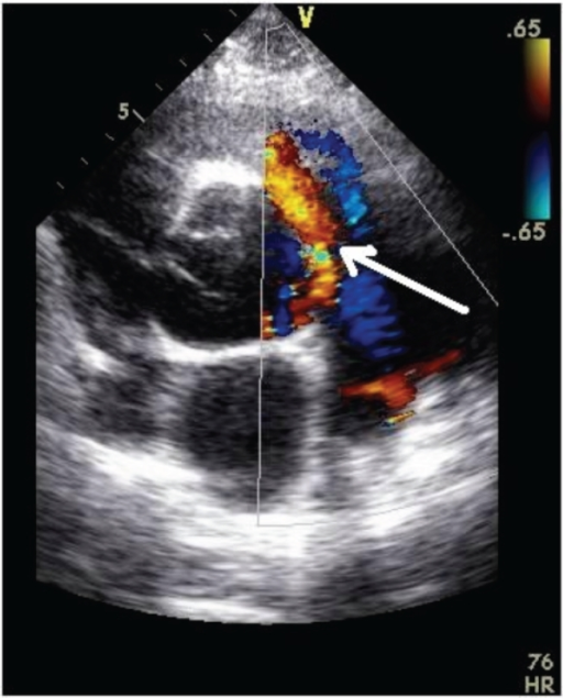 Patent Ductus Arteriosus Echocardiography