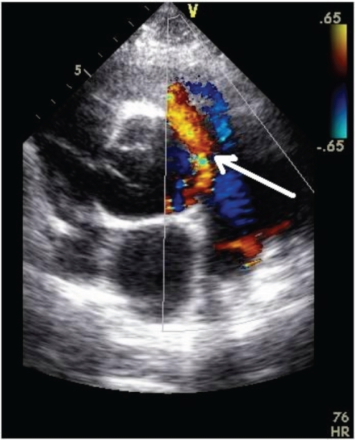 Transthoracic echocardiography image showing the patent | Open-i