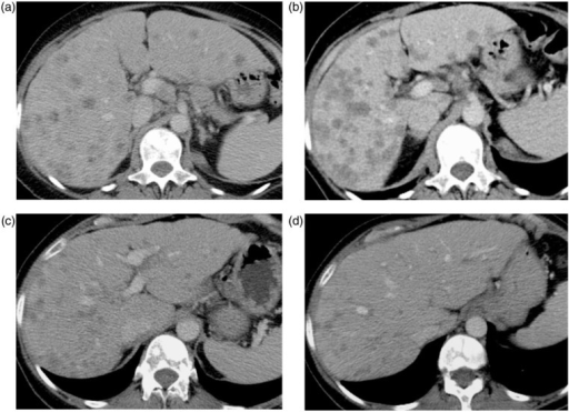 Metastatic nonsmall cell lung cancer (NSCLC) on crizot