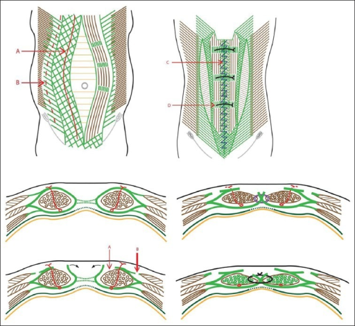 Schematic Diagrams Of Rectus Sheath Turn Over And Exter Open I