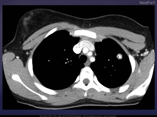 There Is A Left Upper Lobe Pulmonary Nodule Which Measu 