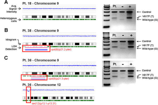 SNP karyograms confirm loss of heterozygosity in patien | Open-i