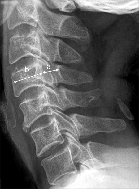 the-sagittal-diameter-of-the-spinal-canal-a-is-measur-open-i