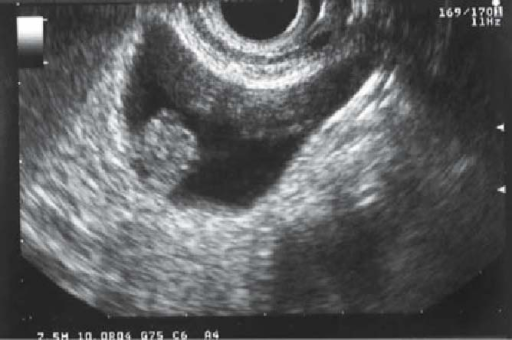 Ultrasound image of adenoma of the gallbladder: this im | Open-i