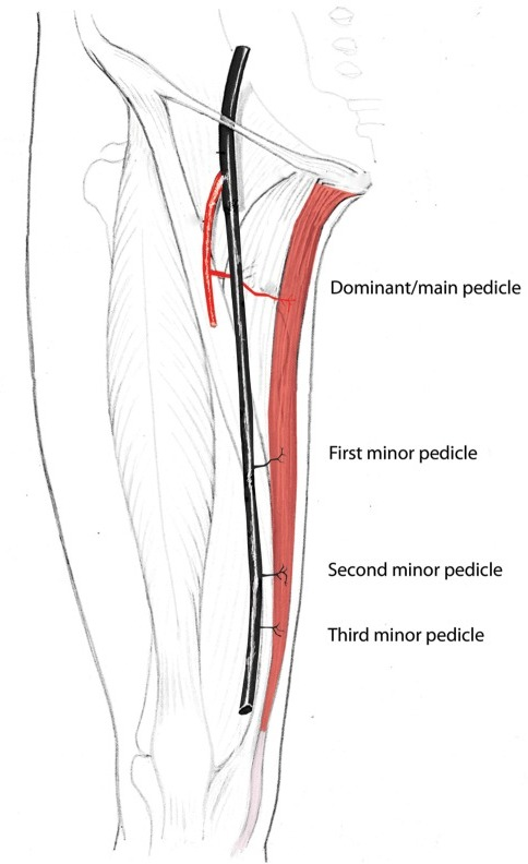 Blood supply to the gracilis flap clarifying the nomenc | Open-i