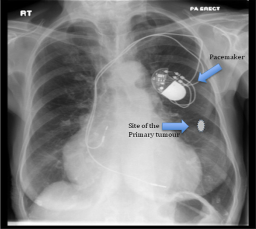 Chest xray of the patient showing the pacemaker in sit