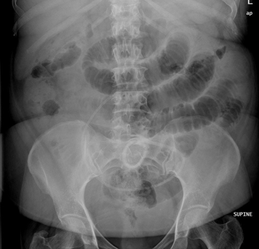 Supine abdomen X-Ray showed small bowel dilatation and | Open-i