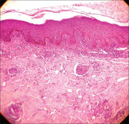 Photomicrograph showing epidermal hyperplasia with a di | Open-i