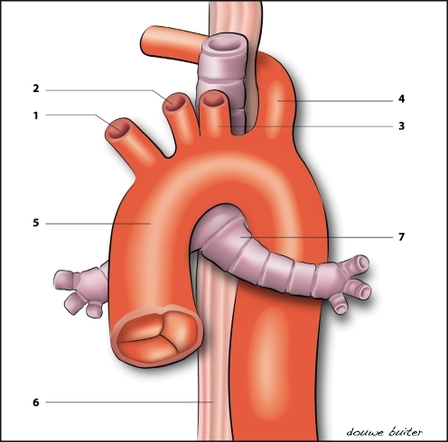 Anatomy of an aberrant right subclavian artery. Right c | Open-i