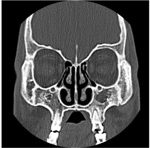 Paranasal Sinus Ct Coronal Section Indicating Aplasia Open I