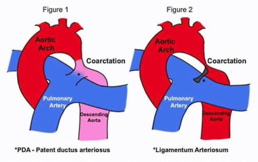 Duct Dependent Coarctation Of The Aorta Adapted From H Open I