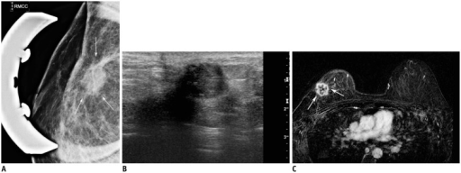 A 41-year-old woman presented with invasive breast car- cinoma of
