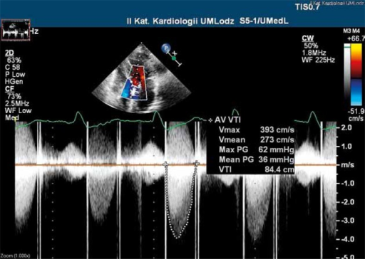 Transthoracic echocardiogram, 5-chamber apical view: in | Open-i