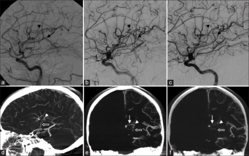 cerebral arteriovenous malformation essay Arteriovenous malformation (avm) intracranial aneurysm – localized dilation of a cerebral artery, most commonly berry shaped – usually arising from an. cerebral arteriovenous malformation essay Arteriovenous malformation (avm) intracranial aneurysm – localized dilation of a cerebral artery, most commonly berry shaped – usually arising from an.