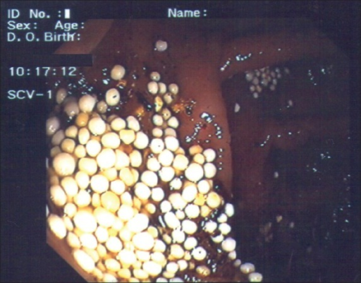 Endoscopic View Of The Colon Intraluminal Presence Of