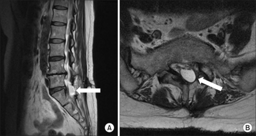 Magnetic resonance imaging T2 sagittal image (A) shows | Open-i