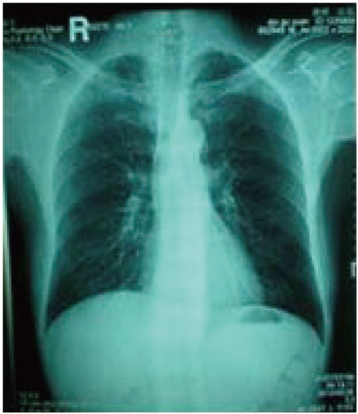 Radiograph Of The Lungs Lung Markings Of Both Lungs Ar Open i surface-markings-of-lungs-earth-s-lab