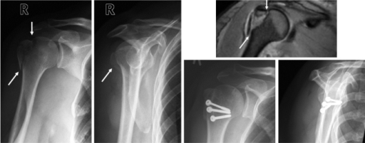 Patient no. 9 (Table 3) before and after open reduction | Open-i