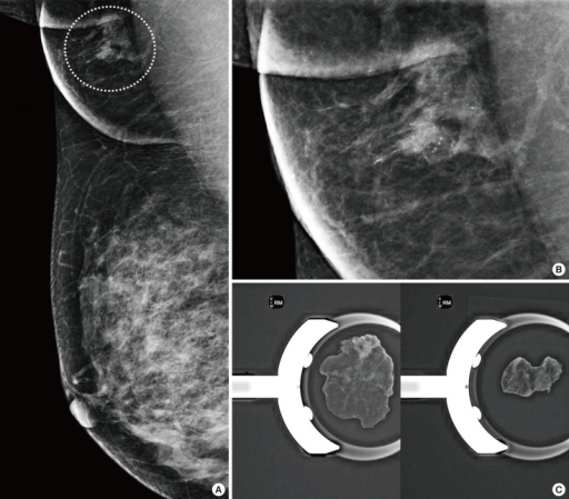 Mammographic Findings Of Ectopic Breast Cancer A Abe Open I