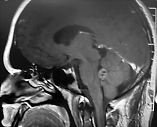 fourth ventricle mri