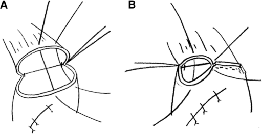 A stay suture was applied to the center of the posterio | Open-i