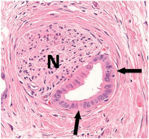 Histological evidence of perineural invasion in a patie | Open-i