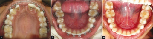 JCDR - Alignment, Canine lacebacks, Incisor crowding, Open coil springs,  Sliding mechanics