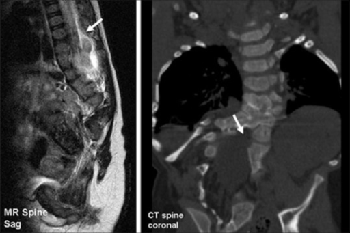 Computed tomography scan of the dorso-lumbar spine showing no