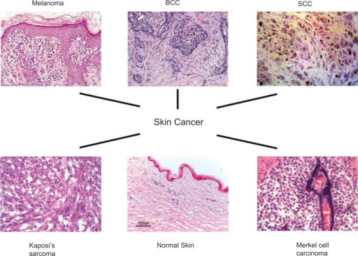 The characteristic histology of melanoma, BCC, SCC, and | Open-i