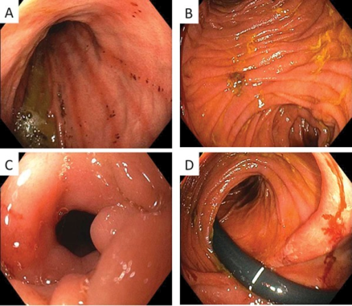 Endoscopy after bypass surgery for CD. A, Mild gastric ...