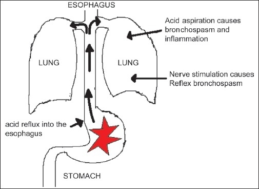 The gastric acid reflux into the esophagus and trachea ...